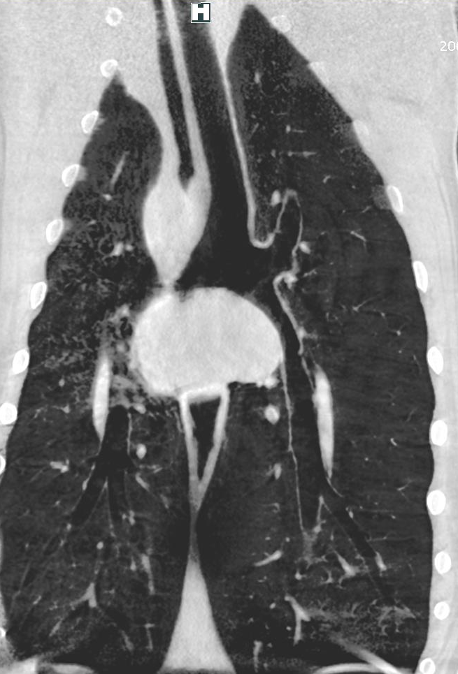 Lung Slice