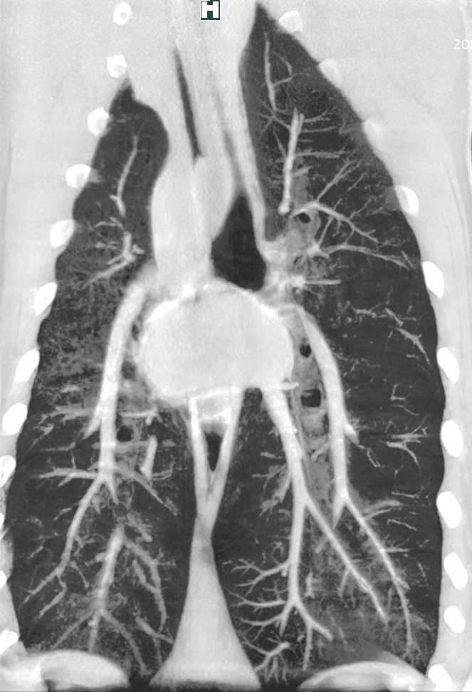 Lung Slice